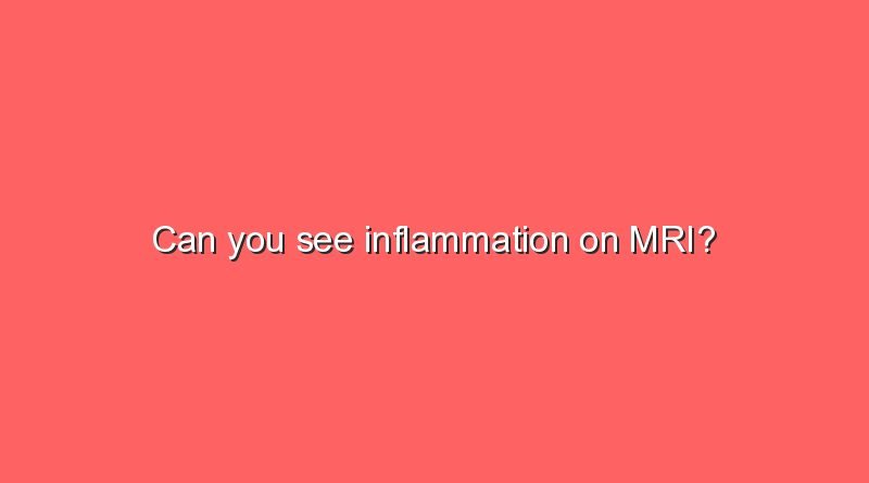 can you see inflammation on mri 11351